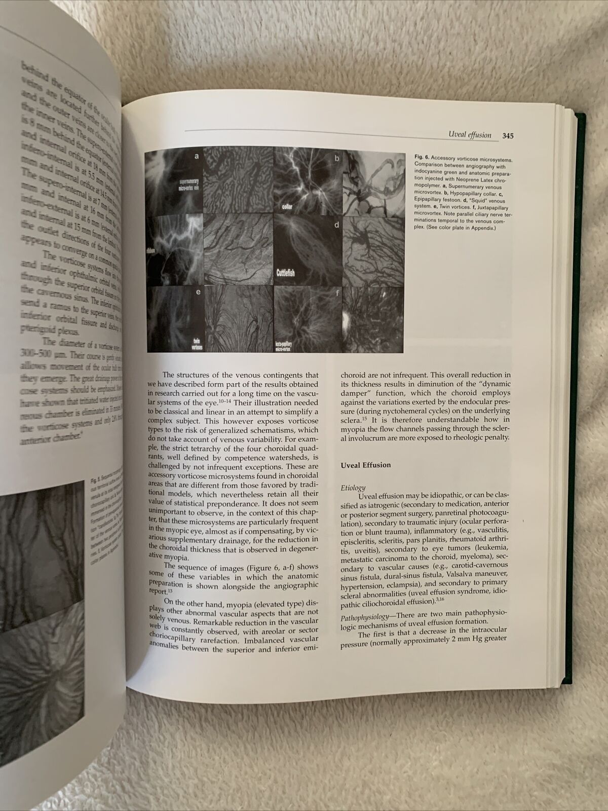 MYOPIA AND RELATED DISEASES. EDOARDO MIDENA. G. B. BIETTI 2005 OFTALMOLOGIA